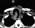 Thyroid cancer - CT scan