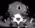 Thyroid cancer - CT scan