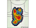 Thyroid enlargement - scintiscan