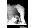 Stomach ulcer, X-ray