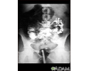 Volvulus - X-ray