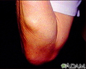 Lipoma - arm