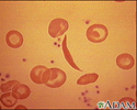Red blood cells, sickle cell