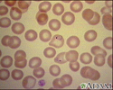 Malaria, microscopic view of cellular parasites