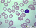Megaloblastic anemia - view of red blood cells