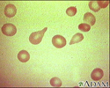 Red blood cells, tear-drop shape