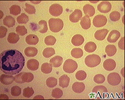 Red blood cells - spherocytosis
