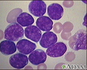 Acute lymphocytic leukemia - photomicrograph