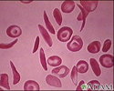 Red blood cells - multiple sickle cells