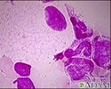 Niemann-Pick foamy cells