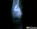 Osteogenic sarcoma - X-ray