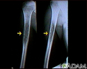 Ewing sarcoma - X-ray