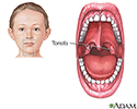 Tonsillectomy - Series