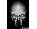 Neurofibromatosis I - enlarged optic foramen