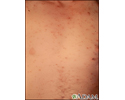 Chickenpox - lesions on the chest