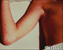 Rocky mountain spotted fever on the arm