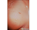Impetigo - bullous on the buttocks