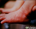 Erythema toxicum on the foot