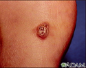 Kaposi sarcoma - lesion on the foot