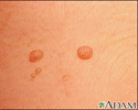 Molluscum contagiosum - close-up