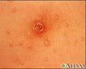 Molluscum contagiosum - close-up of the chest