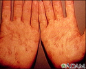 Syphilis - secondary on the palms
