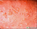 Dermatitis, herpetiformis - close-up of lesion