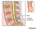 Spinal bone graft - series