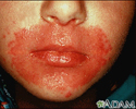 Candidiasis, cutaneous - around the mouth