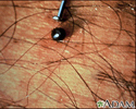 Tick - deer engorged on the skin