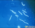 Lyme disease - Borrelia burgdorferi organism