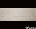 Atrioventricular block - ECG tracing