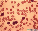 Chronic lymphocytic leukemia - microscopic view