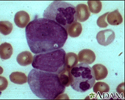 Chronic myelocytic leukemia