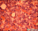 Chronic myelocytic leukemia