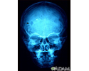 Eosinophilic granuloma - X-ray of the skull