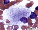 Gaucher cell - photomicrograph