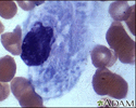 Gaucher cell - photomicrograph #2