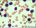 Hairy cell leukemia - microscopic view