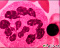 Hypersegmented PMN (Close-up)