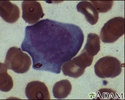 Mononucleosis - photomicrograph of cells