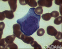 Mononucleosis - photomicrograph of cells