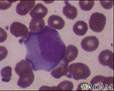 Infectious mononucleosis #3