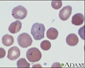 Malaria, microscopic view of cellular parasites