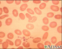 Ovalocytoses