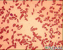 Red blood cells - sickle cells