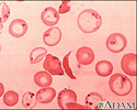 Red blood cells - sickle and Pappenheimer