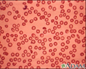 Thalassemia minor