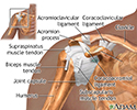 Shoulder separation - Series