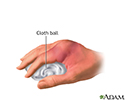 Hand splint - series